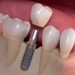 Missing Teeth Replacement - Best Alternative Among All the Options