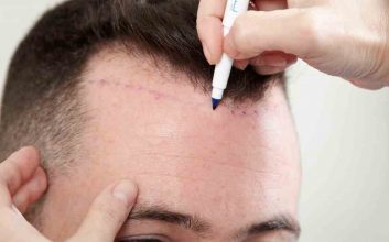 Hair Transplant Clinic