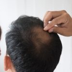 Top 7 Ways to Stop Hair Loss for Men
