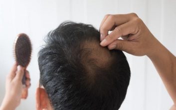 Top 7 Ways to Stop Hair Loss for Men