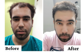 Hair Transplant Surgery