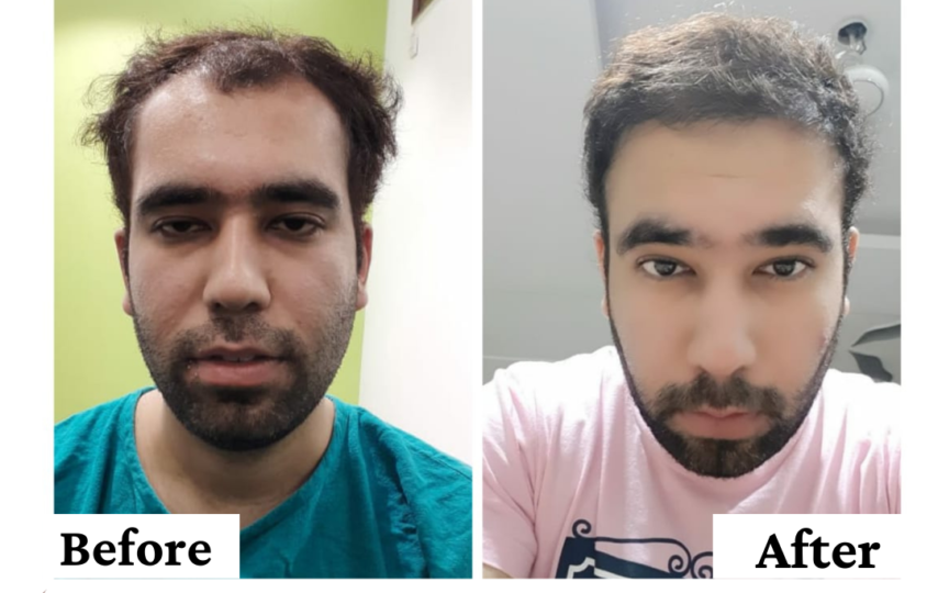 Hair Transplant Surgery